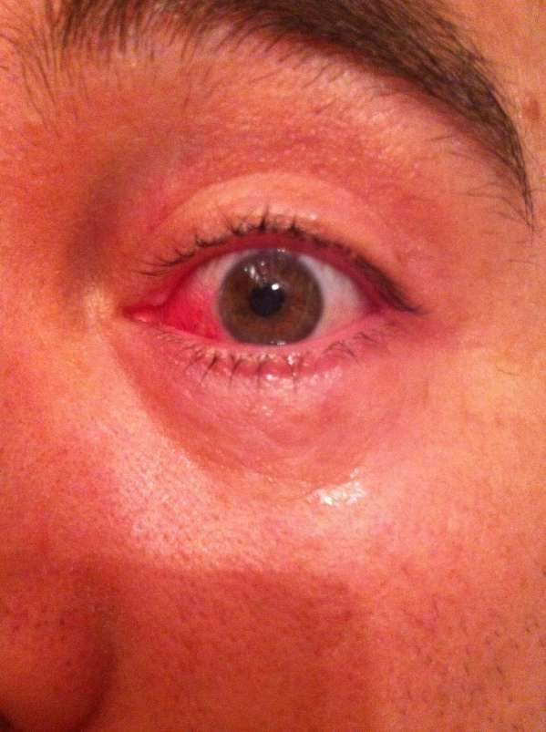 Day 10 Pterygium Excision_compressed