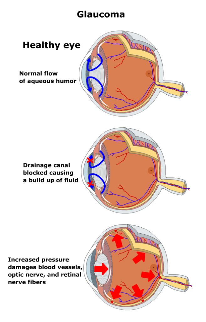 Glaucoma-657x1024_compressed