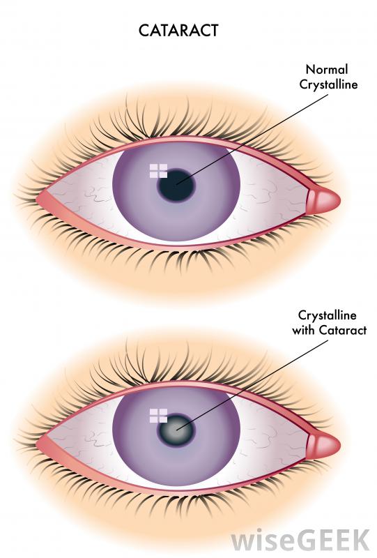 depiction-of-cataracts